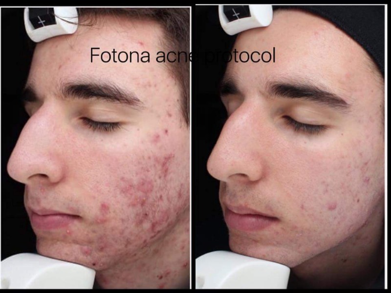 Laser treatment of acne  Photo